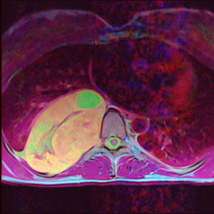 Intercostal nerve schwannoma in false color.  This slice shows the tumor's closest approach to the spinal cord.  The spinal cord appears dark purple against the green cerebrospinal fluid.  The heart appears as a large, blurry oval at the front of the chest cavity.  This image combines three axial thoracic spine MRI sequences, with T1-weighted fat-saturated with contrast as the red channel, T2-weighted as the green channel, and T1-weighted as the blue channel.
