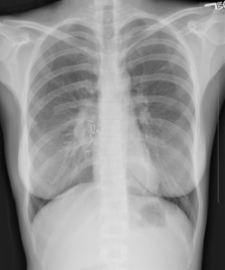 Chest x-ray two weeks after surgery.  It shows titanium clips, resection of part of the seventh rib, an area of scar tissue, and normally inflated lungs.