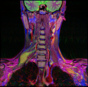Brachial plexus schwannoma in false color.  The adjacent cervical spinal nerves appear green.  Nerves are only visible on one side because the slice is slightly oblique.  This image combines three coronal neck MRI sequences, with T1-weighted fat-saturated with contrast as the red channel, STIR as the green channel, and T1-weighted as the blue channel.